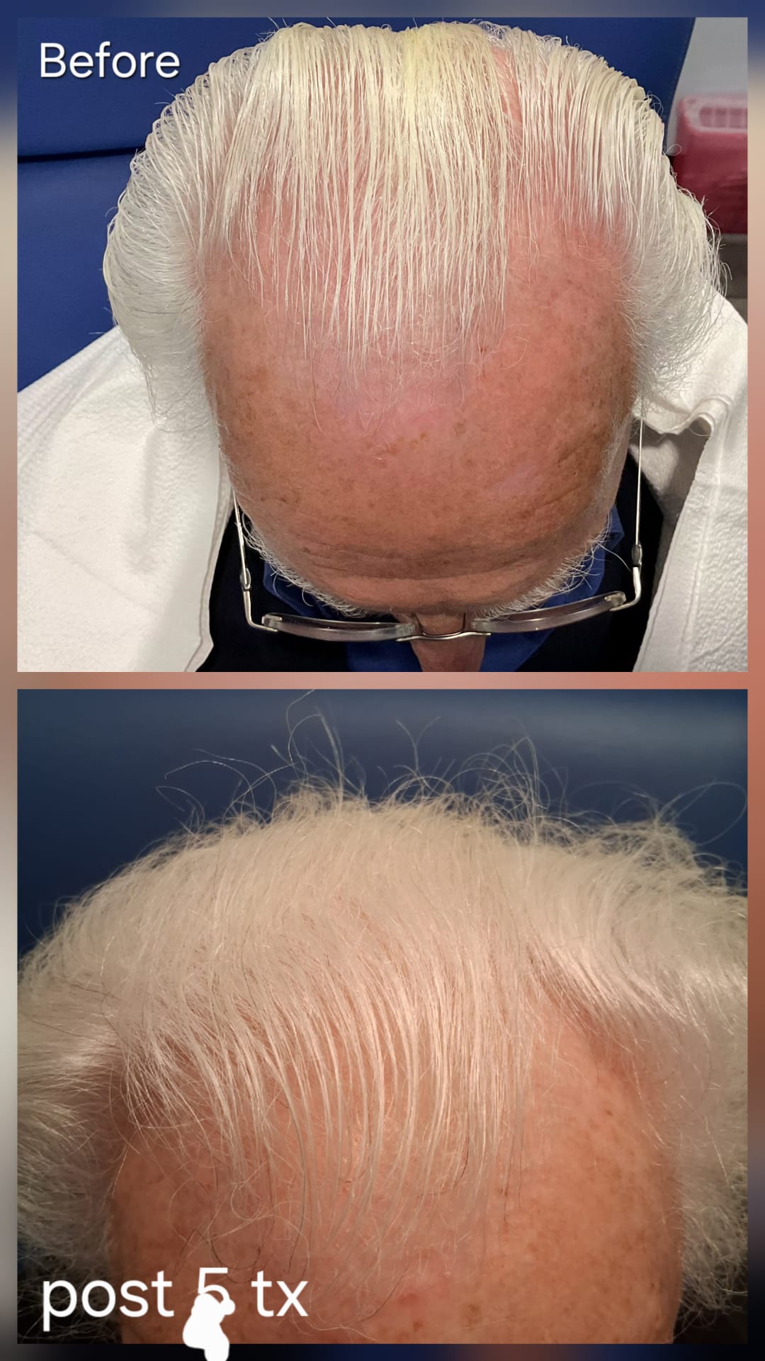 Hair restoration result